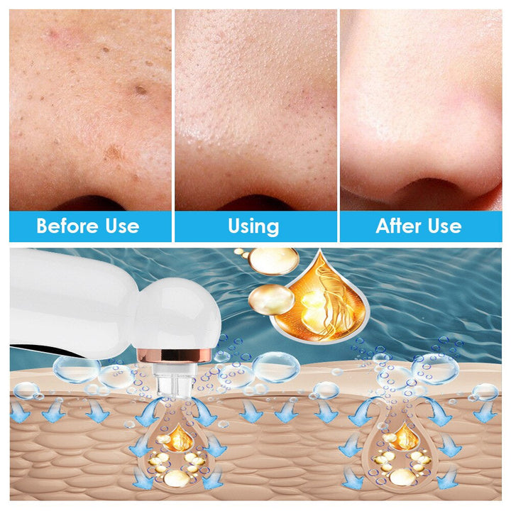 Dermatologisch inspiriertes Hydrodermabrasion Gerät. Tiefenreinigung der Haut, entfernt Mitesser & verfeinert Poren.