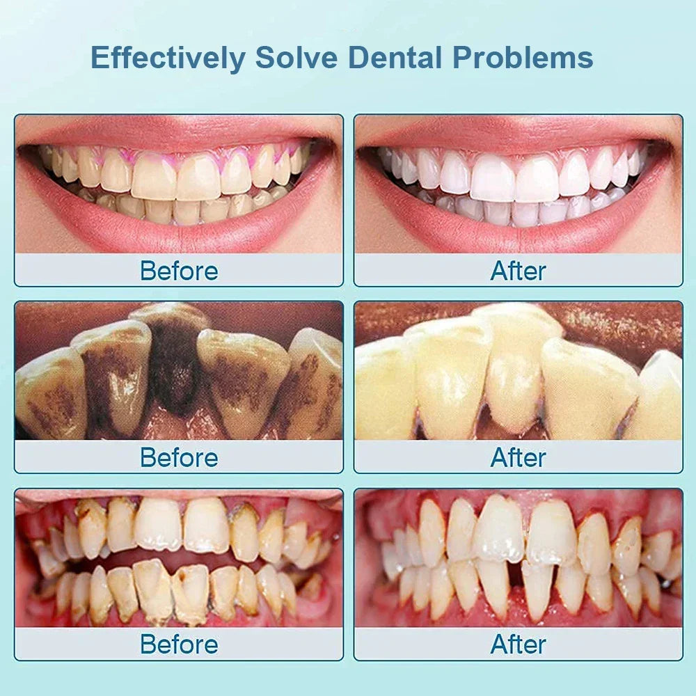 Dieser Ultraschall-Dentalreiniger entfernt Zahnstein & Plaque. Für optimale Mundhygiene, weiße Zähne & ein gesundes Lächeln.