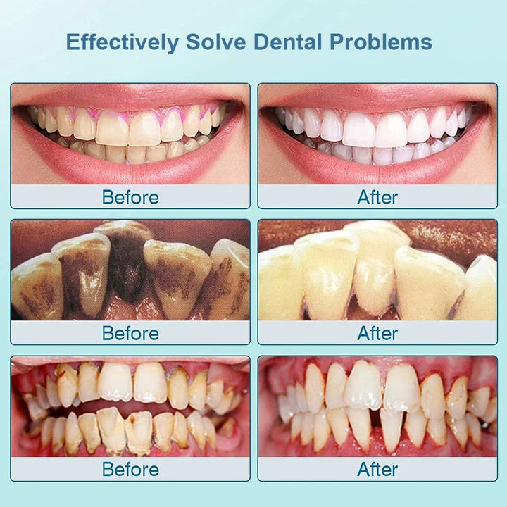 Dieser Ultraschall-Dentalreiniger entfernt Zahnstein & Plaque. Für optimale Mundhygiene, weiße Zähne & ein gesundes Lächeln.