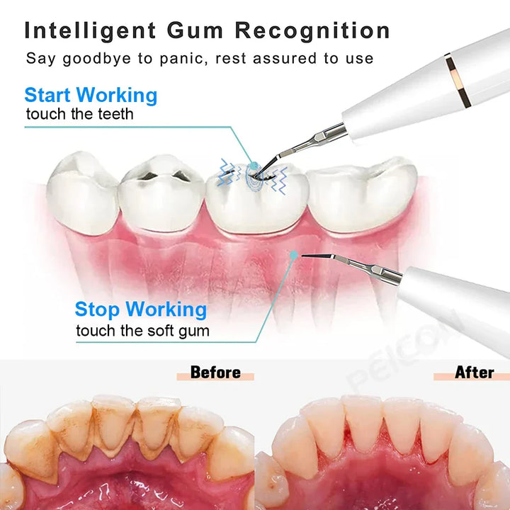 Modernes Ultraschall-Dentalreiniger-Set. Effektive Plaque- & Zahnsteinentfernung für ein gesundes Lächeln & Mundhygiene.