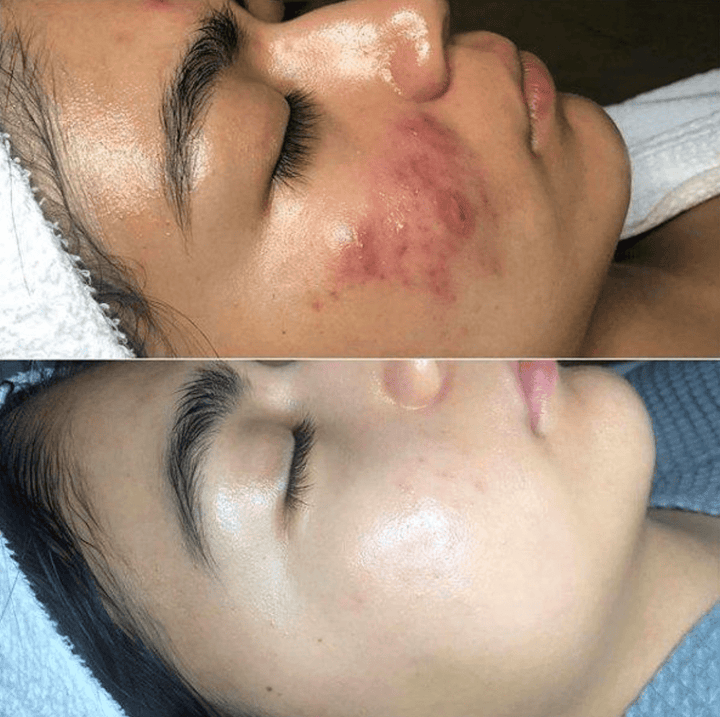 Kompaktes Hochfrequenz Gerät zur Heimanwendung. Ideal für Akne, Anti-Aging & Haarausfallbehandlung.