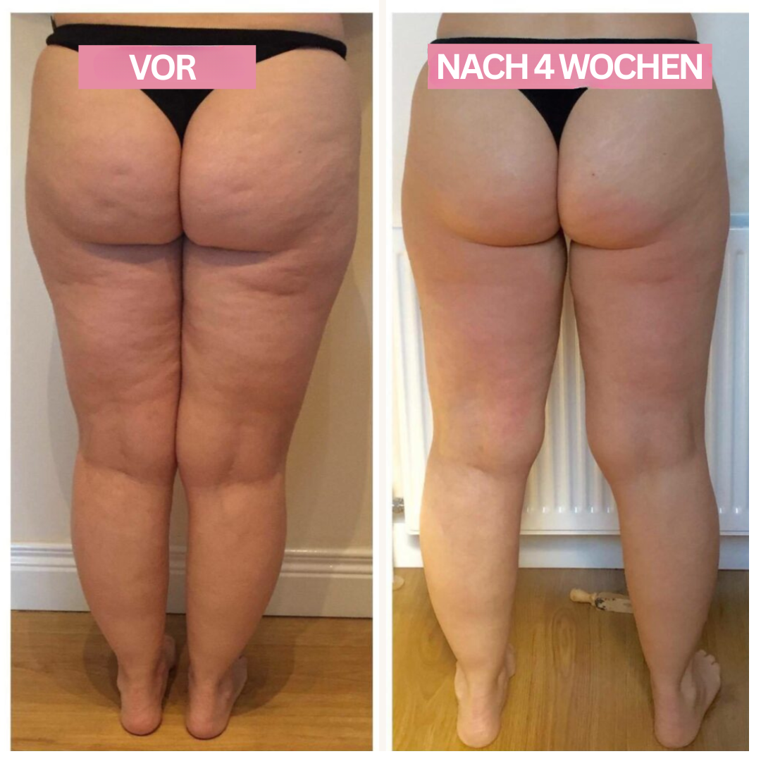 Modernes Anti-Cellulite Cupping Gerät mit Infrarot für Tiefenmassage & Hautglättung.