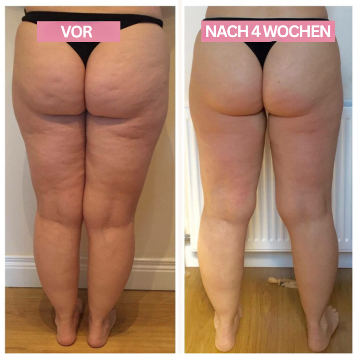 Modernes Anti-Cellulite Cupping Gerät mit Infrarot für Tiefenmassage & Hautglättung.